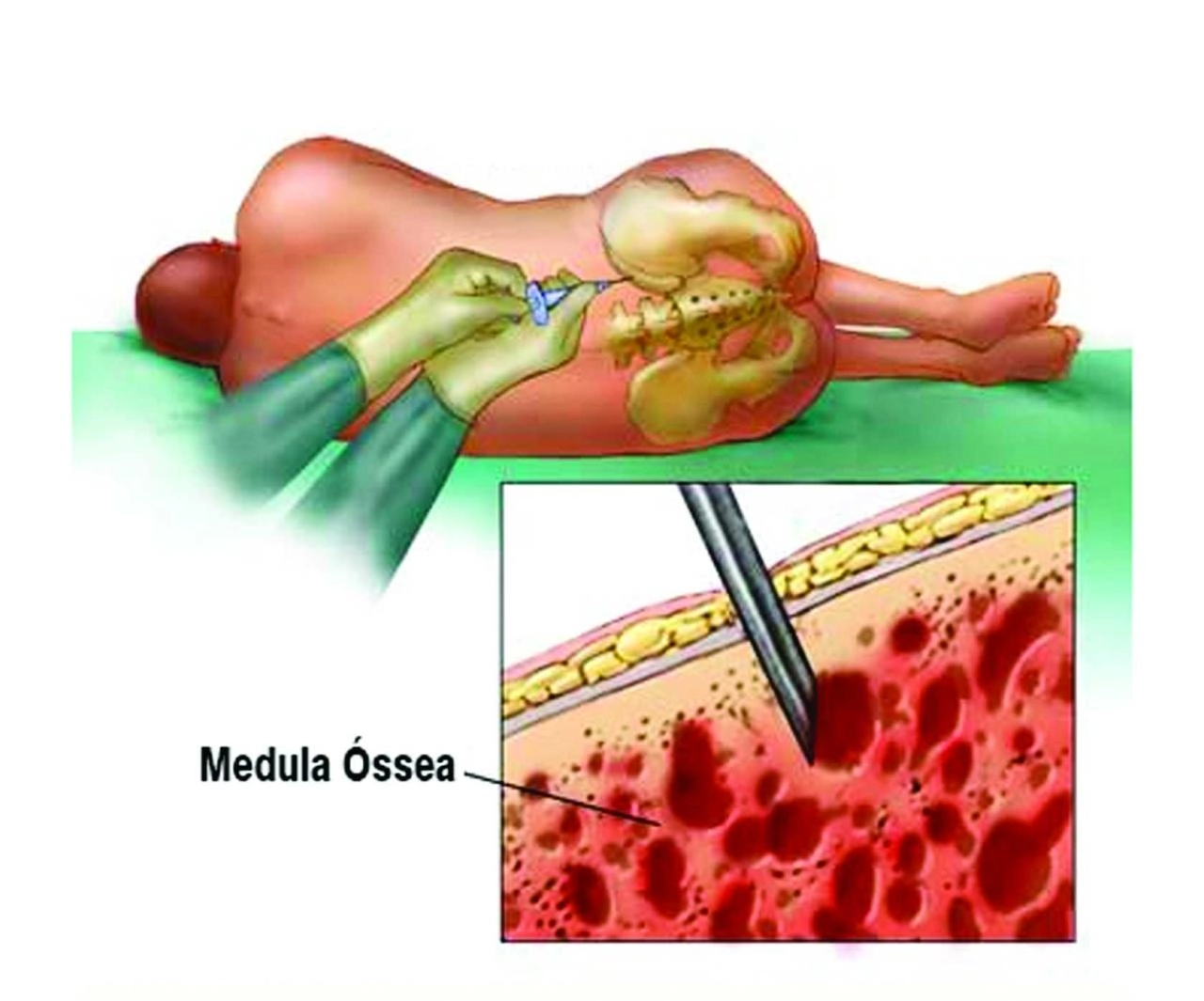SUCESSO NO PROCEDIMENTO: Hospital de Base realiza primeiro transplante de medula óssea